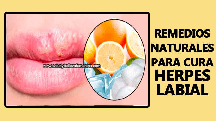 Remedios naturales para curar Herpes labial
