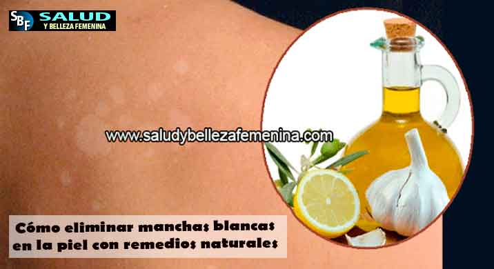 Cómo eliminar manchas blancas en la piel con remedios naturales