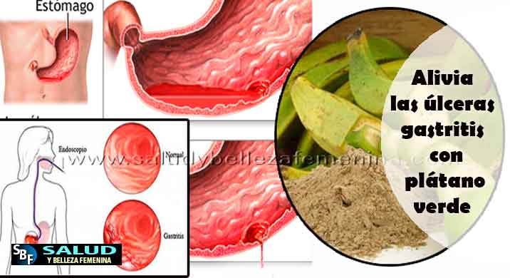 Alivia las úlceras gastritis con plátano verde
